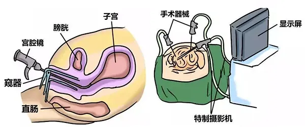 宫腔镜手术会影响怀孕吗？哪些宫腔疾病需要做宫腔镜手术？宫腔镜术前和术后注意事项有哪些？