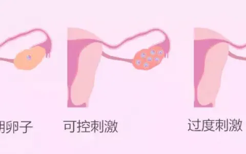 试管婴儿取卵越多越好?小心试管婴儿卵巢过度刺激综合征！