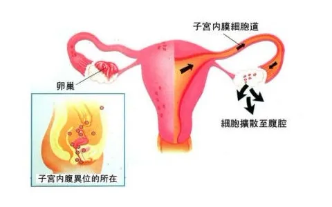 子宫内膜异位症是什么，子宫内膜异位症有哪些症状，子宫内膜异位症的治疗方法
