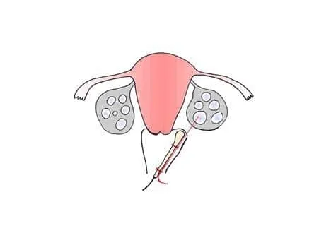 试管婴儿取卵手术具体步骤？试管婴儿取卵会很痛苦吗？