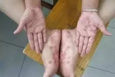 得了梅毒该如何治疗才能做试管婴儿？梅毒治疗多久后可以做试管婴儿？