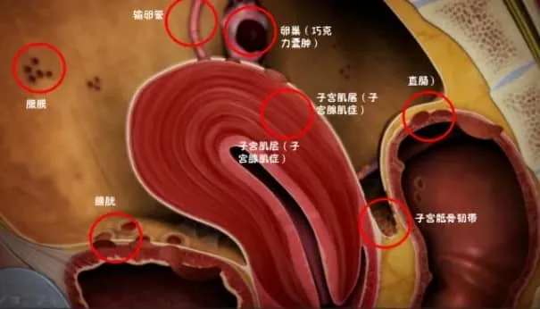 子宫内膜异位症如何影响试管婴儿的成功率？试管婴儿治疗中子宫内膜异位症患者面临哪些挑战？