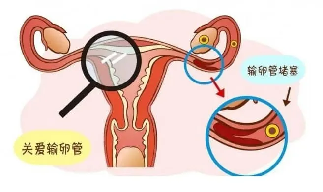 输卵管堵塞做试管婴儿会影响成功率吗？输卵管堵塞做试管婴儿有哪些风险？