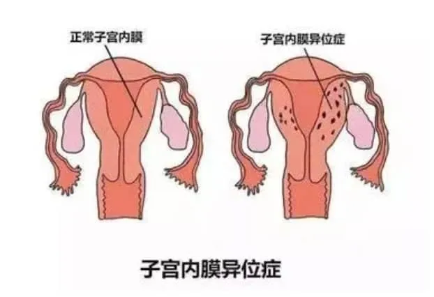 试管婴儿过程中如何科学补充铁元素以避免子宫内膜异位症相关不孕症的风险？