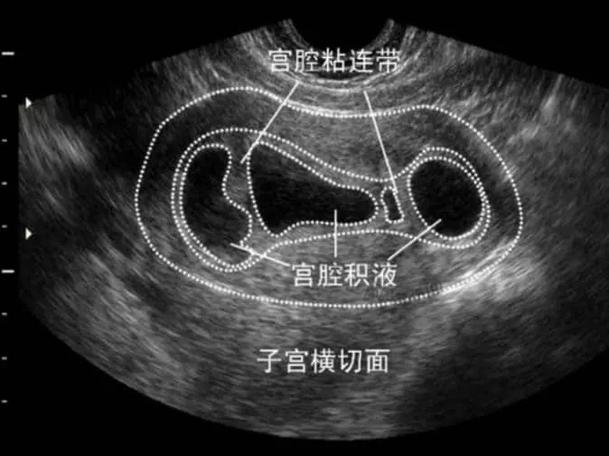宫腔积液是否会影响试管婴儿的成功率？试管婴儿移植过程中遇到宫腔积液应该如何处理？