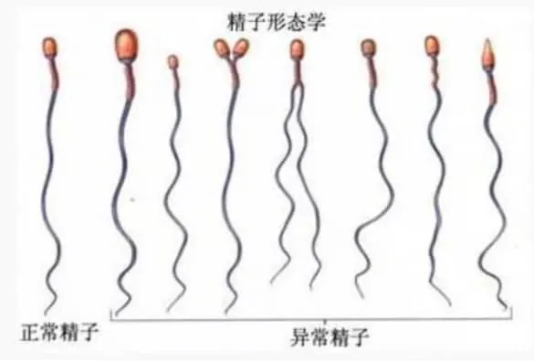 精子形态学异常会影响试管婴儿的结果吗？试管婴儿过程中精子畸形率高应该怎么办？