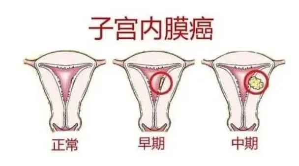 什么是子宫内膜癌？子宫长了癌还有机会生育宝宝吗？子宫内膜癌患者能否通过试管婴儿技术实现生育梦想？