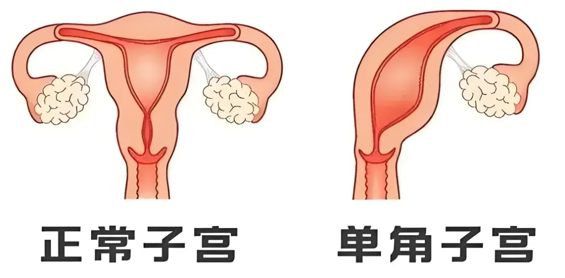 什么是单角子宫？单角子宫会正常怀孕吗？单角子宫怀孕需要注意些什么？