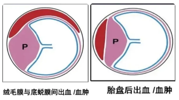 哪些因素会出现绒毛膜下出血？ 早孕期绒毛膜下出血该怎么办？绒毛膜下出血对怀孕有哪些影响？