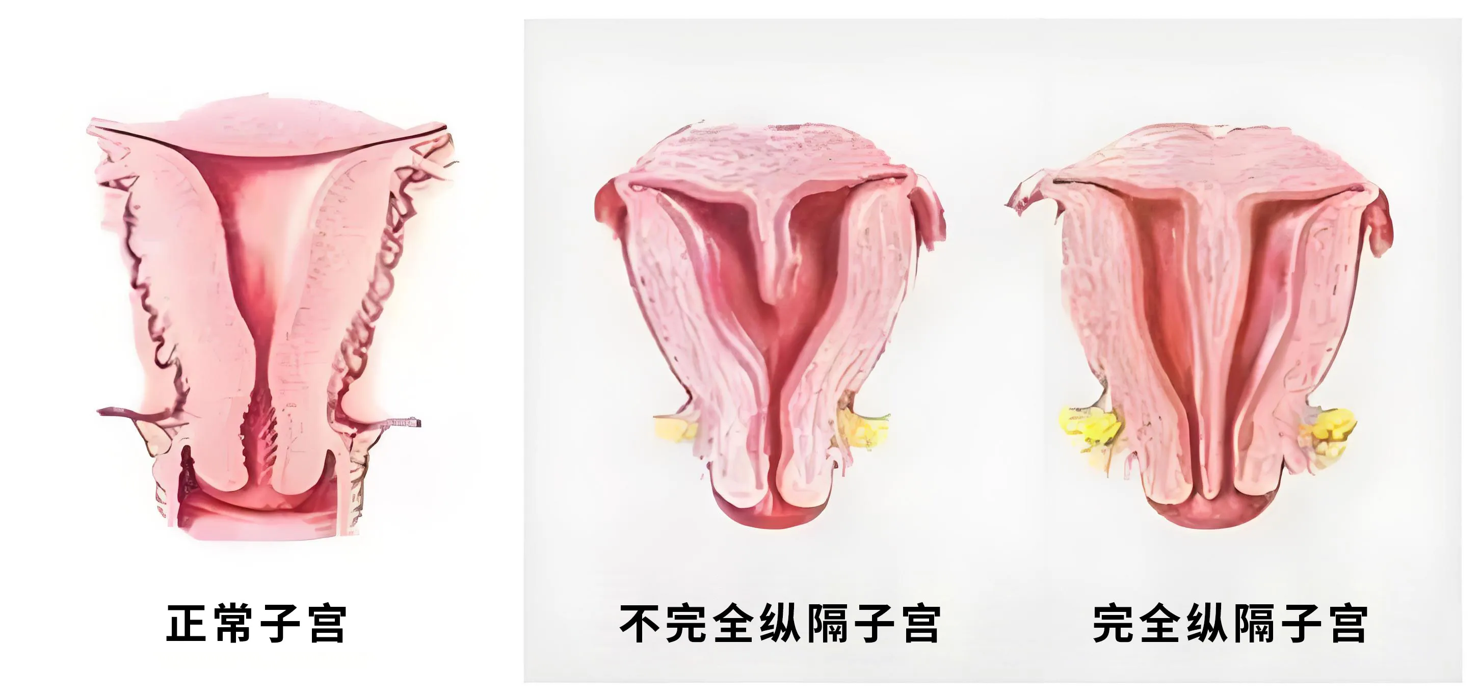  完全纵隔子宫和不完全纵隔子宫有什么区别？导致子宫纵膈的原因有哪些？纵隔子宫通过哪些检查确诊出来？