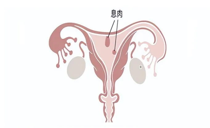 什么是子宫内膜息肉？子宫内膜息肉的病因有哪些？子宫内膜息肉会影响试管婴儿成功率吗？