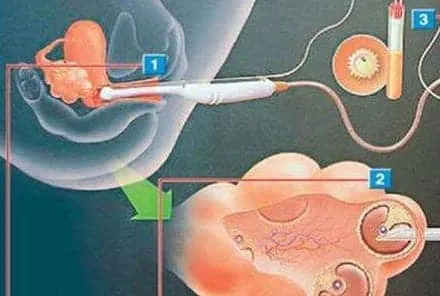 人工授精几天能测怀孕？人工授精几天可以同房？人工授精后需要注意些什么？