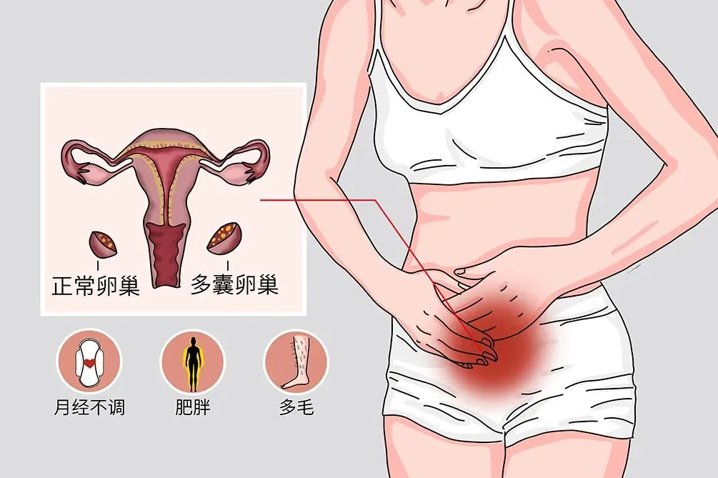 多囊卵巢综合征会导致不孕吗？多囊患者如何提高成功率？