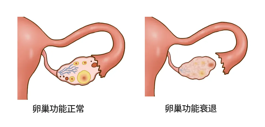 卵巢功能衰退如何影响卵子质量？如何改善卵泡液提升卵子质量？