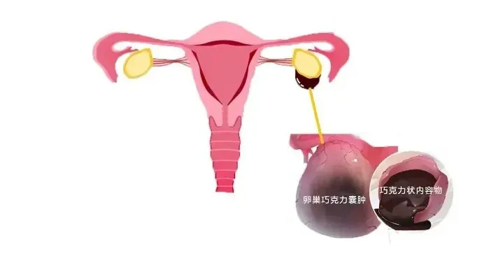 "卵巢囊肿会影响怀孕吗？备孕发现卵巢囊肿怎么办？如何预防卵巢囊肿？