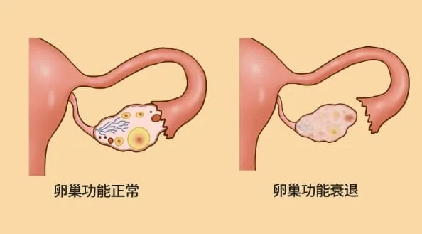 卵巢衰退可以做试管婴儿吗？高龄妇女卵巢衰退会带来什么问题？卵巢衰退如何做试管婴儿？