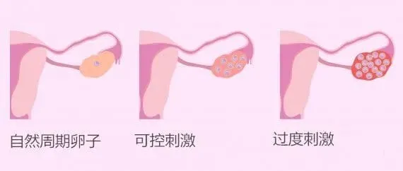 卵巢过度刺激综合征（OHSS）的由来？OHSS的症状是什么？如何降低卵巢过度刺激综合的发生？