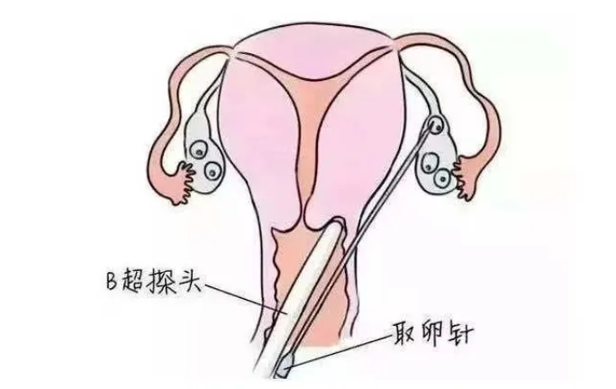 试管婴儿反复促排是否真的会对卵子造成影响？试管婴儿反复促排对后代糖代谢功能的影响有哪些？