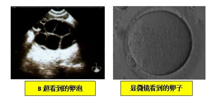 试管婴儿备孕中，卵泡数、取卵数、胚胎数层层缩水，备用方案在哪？