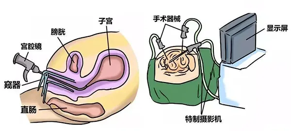 哪些宫腔问题会影响胚胎着床？如何通过宫腔镜检查提高成功率？